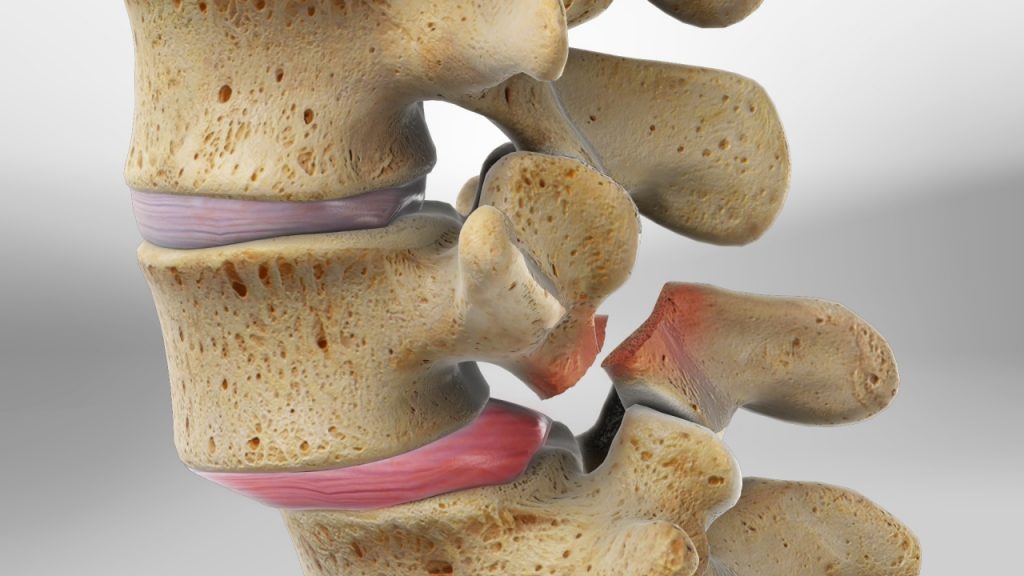 Spondylolisthesis – Causes, Symptoms, and Treatments in Kozhikode