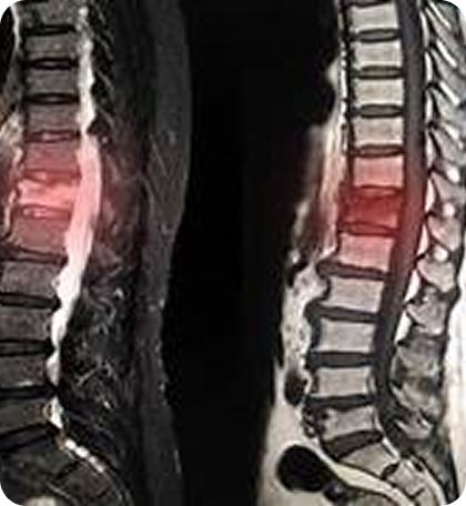 Degenerative Disc Disease