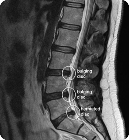 Herniated or Bulging Discs