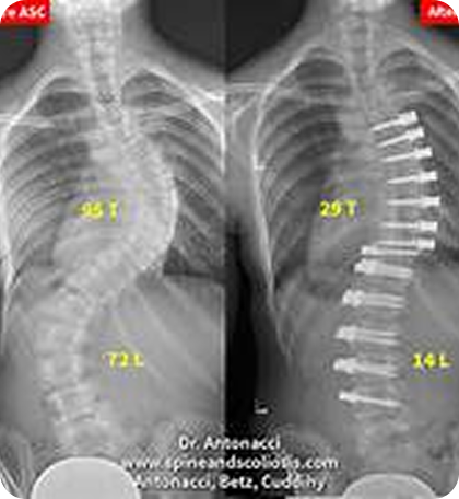 Scoliosis (Curved Spine)