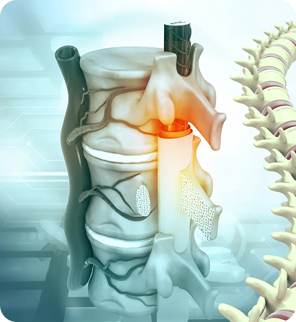 Spinal Stenosis