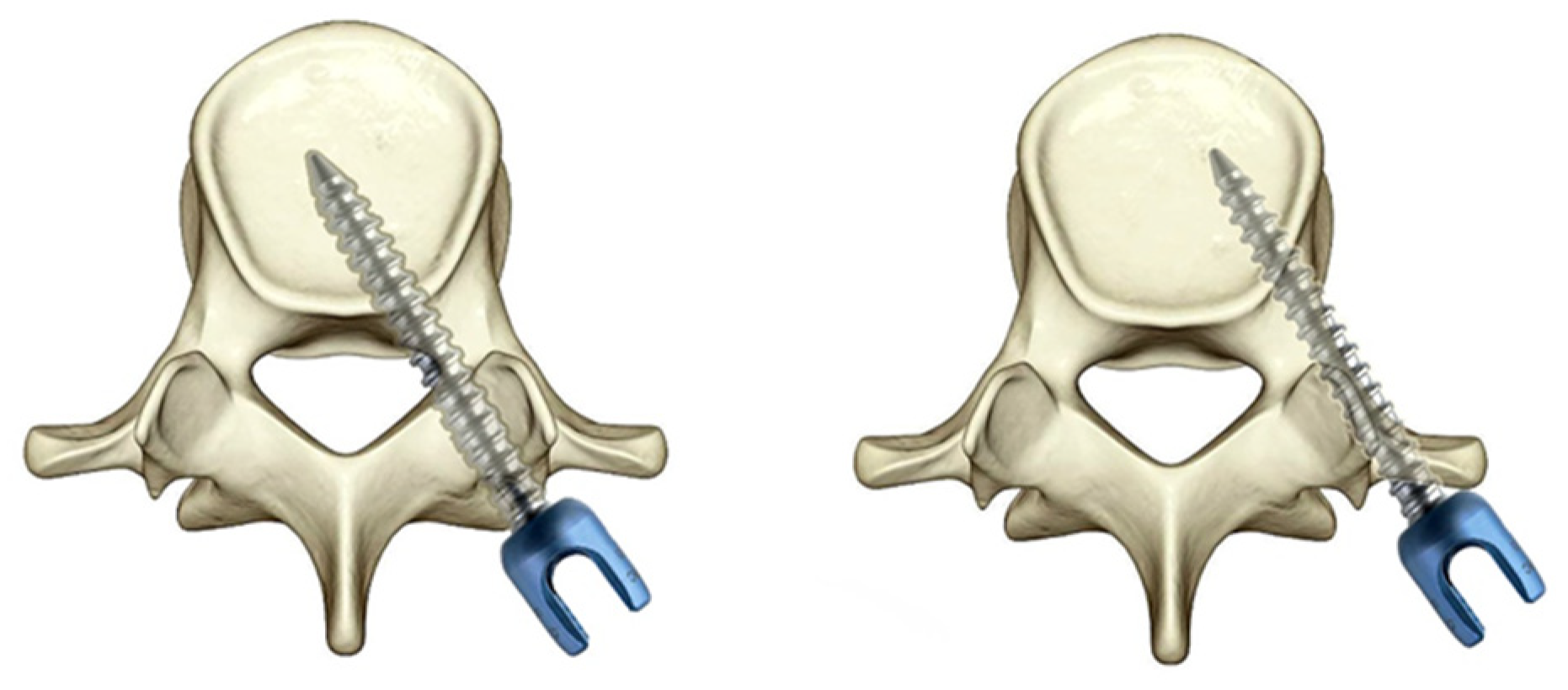 MIS - TLIF detailed medical procedure