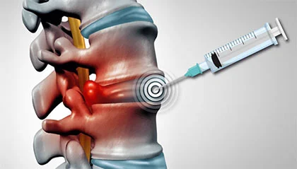 Lumbar & Cervical Epidural Steroid Injections detailed medical procedure