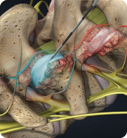 Facet Joint Injections