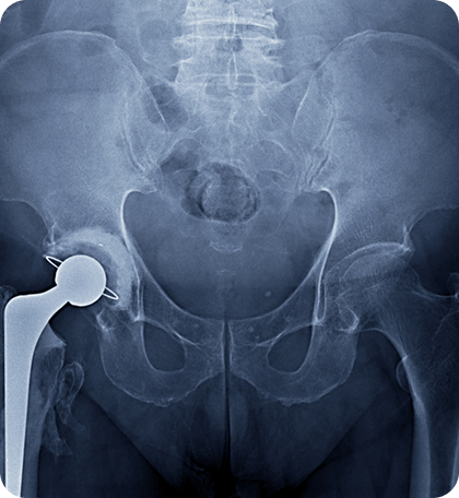 Sacroiliac Joint Injections